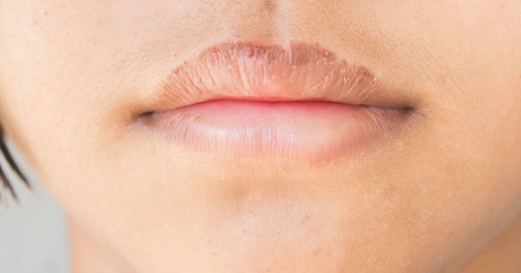फटे होंठो का कैसे रखे ख्याल 2023 – lip care tips at home in hind